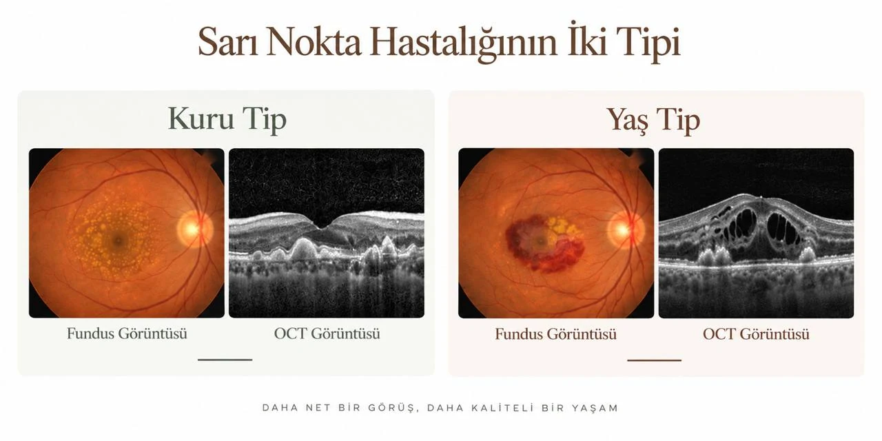 Sarı nokta hastalığının kuru tip ve yaş tip fundus ile OCT görüntü karşılaştırması